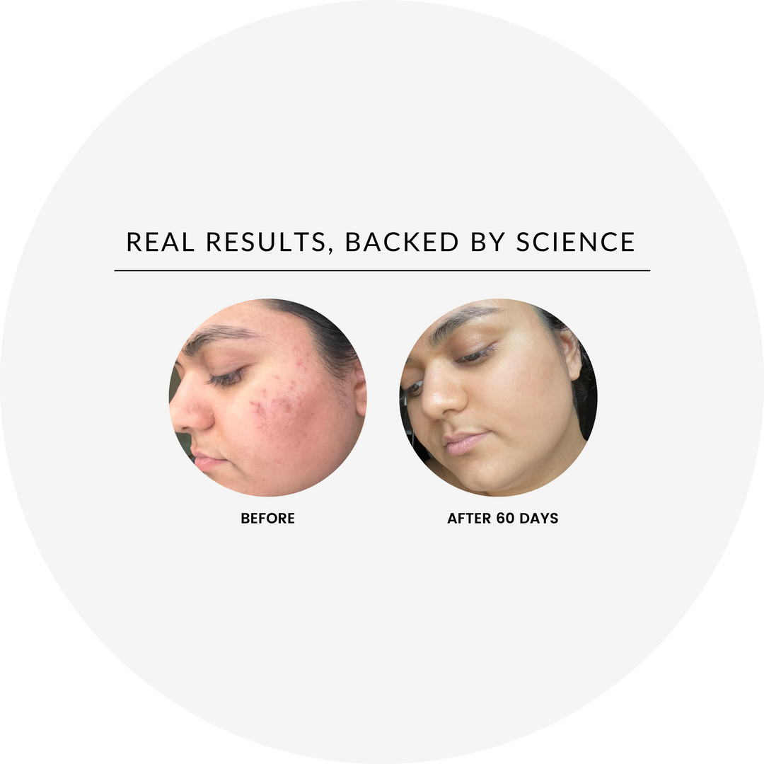 Before-and-after of skin using the vitamin C brightening serum, showing brighter-looking skin.